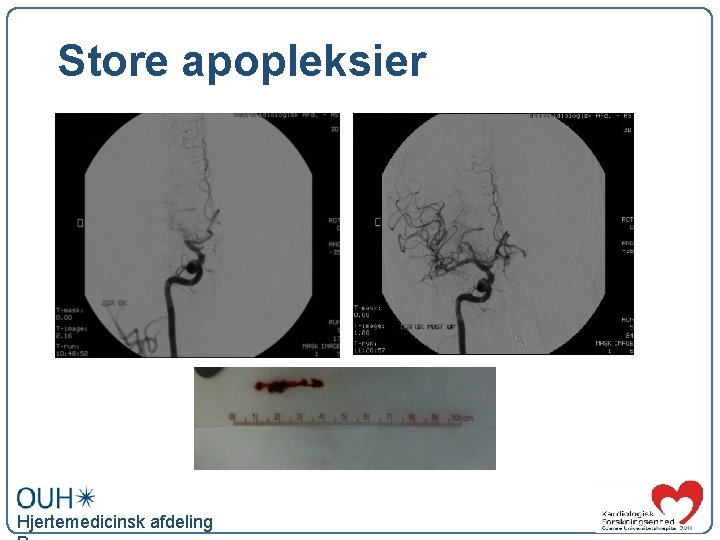 Store apopleksier Hjertemedicinsk afdeling 