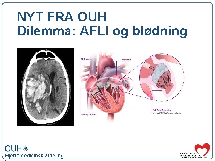NYT FRA OUH Dilemma: AFLI og blødning Alvorlig blødning ved AK-behandling Hjertemedicinsk afdeling 