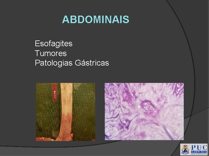 ABDOMINAIS Esofagites Tumores Patologias Gástricas 