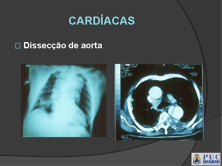 CARDÍACAS � Dissecção de aorta 