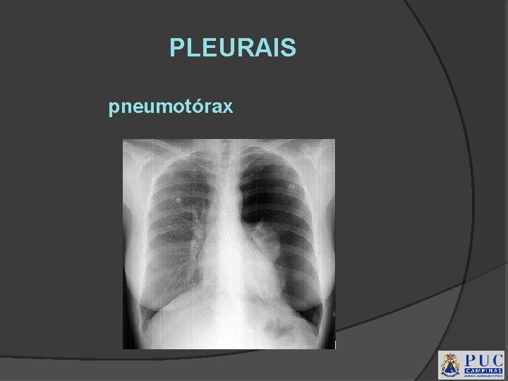 PLEURAIS pneumotórax 