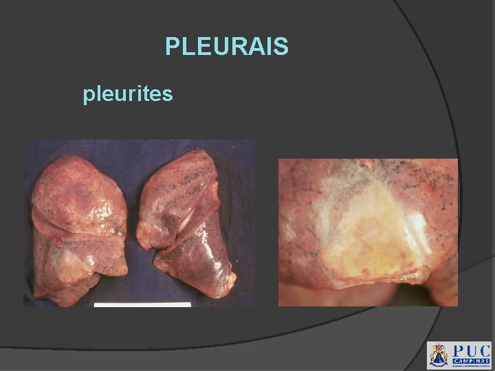 PLEURAIS pleurites 