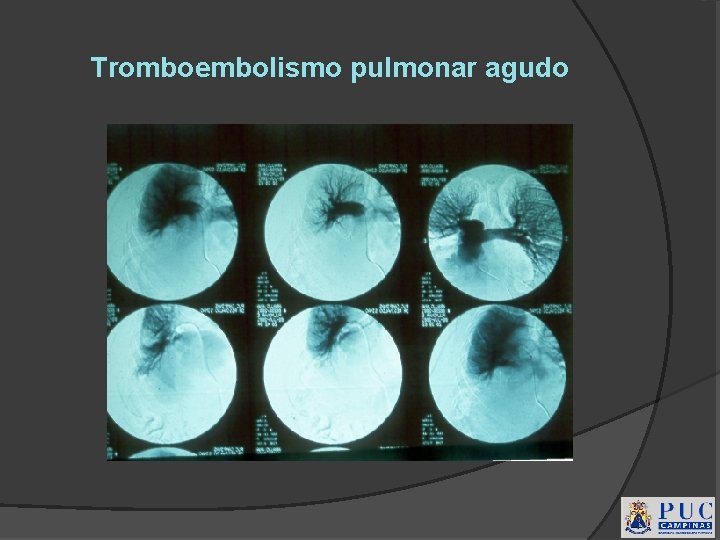 Tromboembolismo pulmonar agudo 