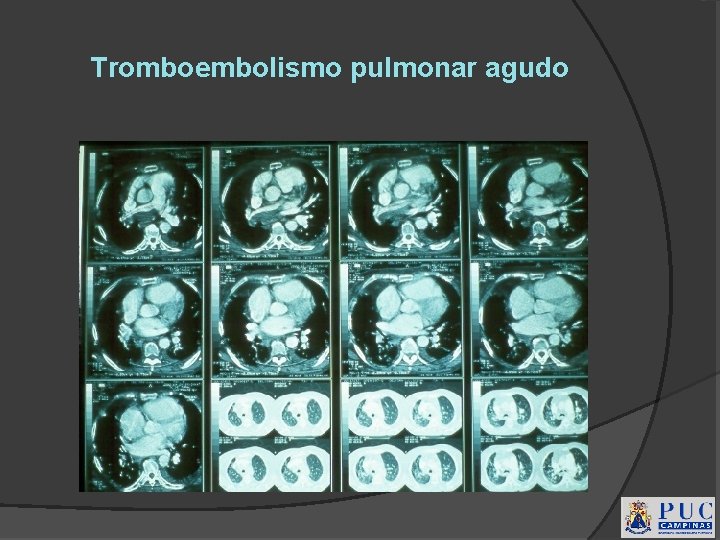 Tromboembolismo pulmonar agudo 