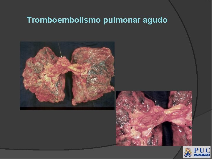 Tromboembolismo pulmonar agudo 