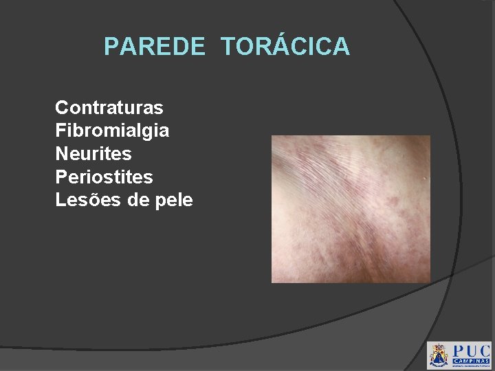 PAREDE TORÁCICA Contraturas Fibromialgia Neurites Periostites Lesões de pele 