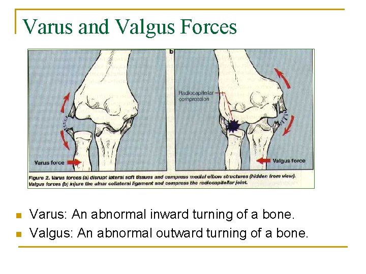 Varus and Valgus Forces n n Varus: An abnormal inward turning of a bone.