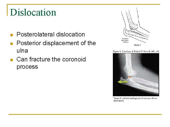 Dislocation n Posterolateral dislocation Posterior displacement of the ulna Can fracture the coronoid process