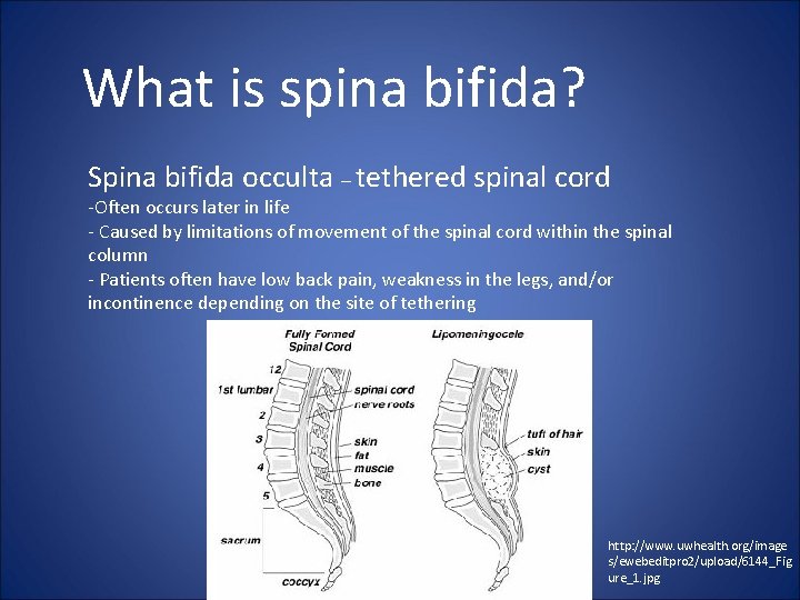 What is spina bifida? Spina bifida occulta – tethered spinal cord -Often occurs later