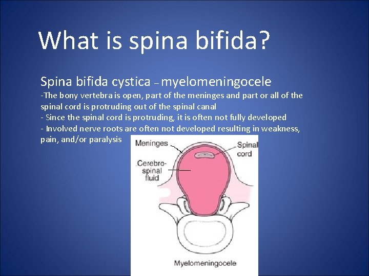 What is spina bifida? Spina bifida cystica – myelomeningocele -The bony vertebra is open,