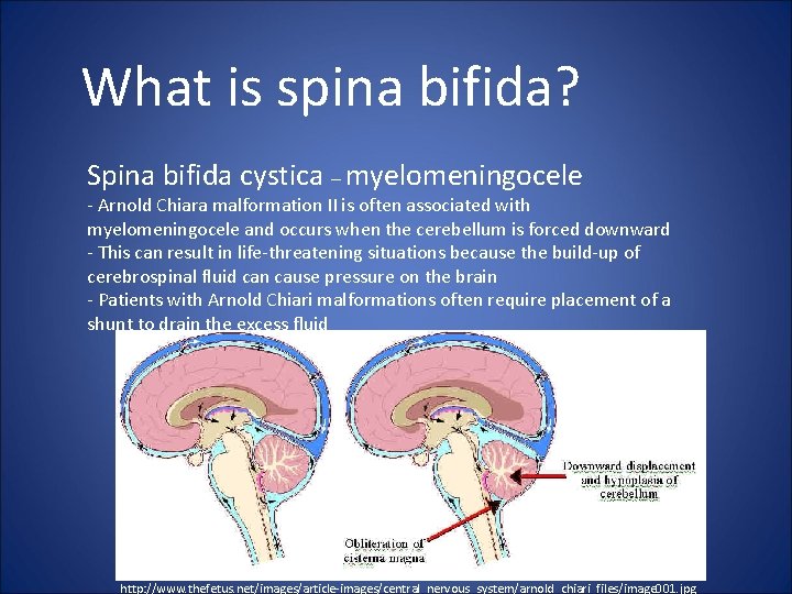 What is spina bifida? Spina bifida cystica – myelomeningocele - Arnold Chiara malformation II