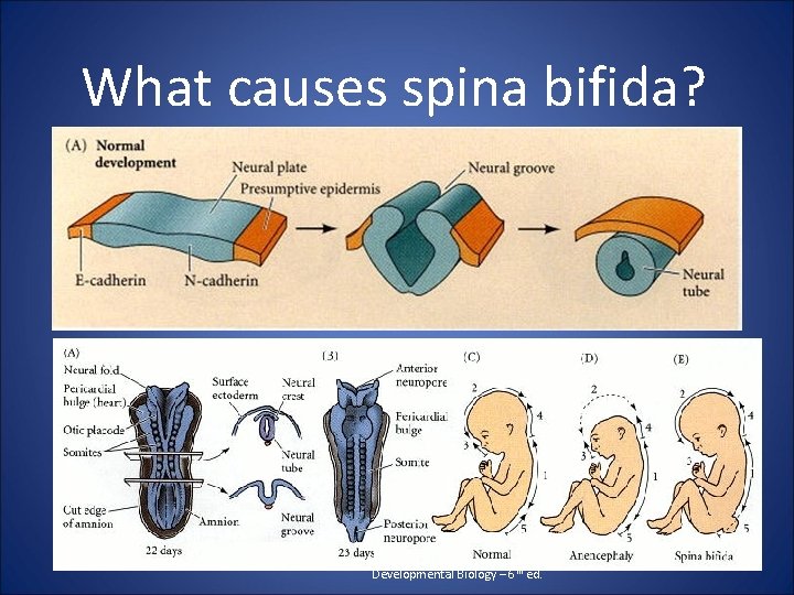 What causes spina bifida? Developmental Biology – 6 th ed. 