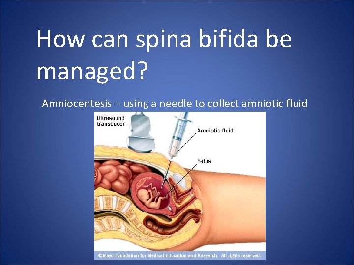 How can spina bifida be managed? Amniocentesis – using a needle to collect amniotic