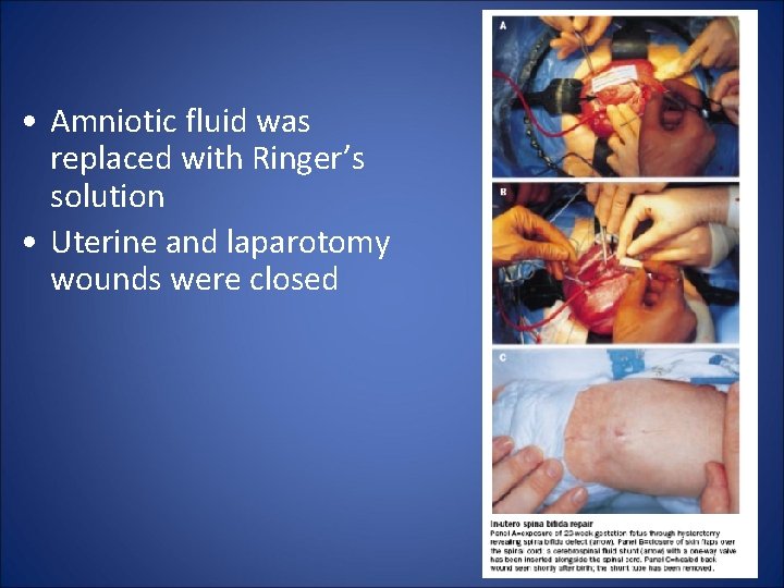  • Amniotic fluid was replaced with Ringer’s solution • Uterine and laparotomy wounds