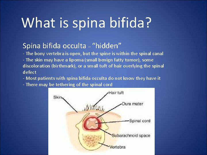 What is spina bifida? Spina bifida occulta – “hidden” - The bony vertebra is