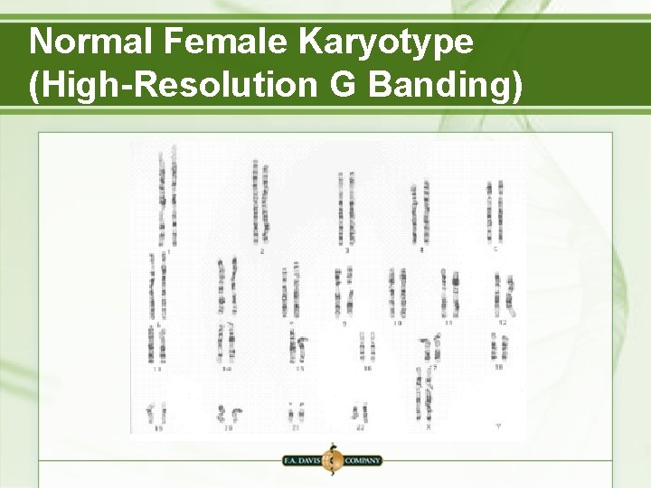 Normal Female Karyotype (High-Resolution G Banding) 