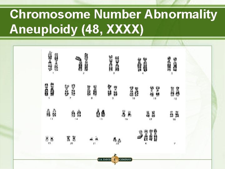 Chromosome Number Abnormality Aneuploidy (48, XXXX) 