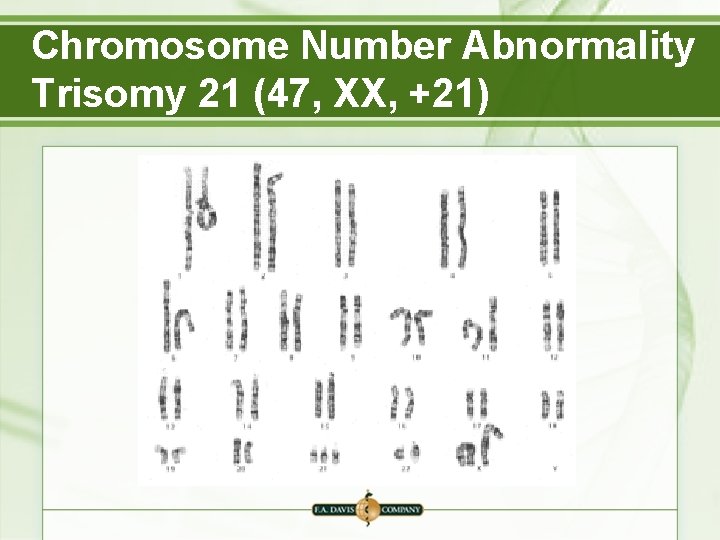 Chromosome Number Abnormality Trisomy 21 (47, XX, +21) 