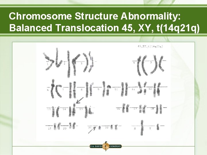 Chromosome Structure Abnormality: Balanced Translocation 45, XY, t(14 q 21 q) 