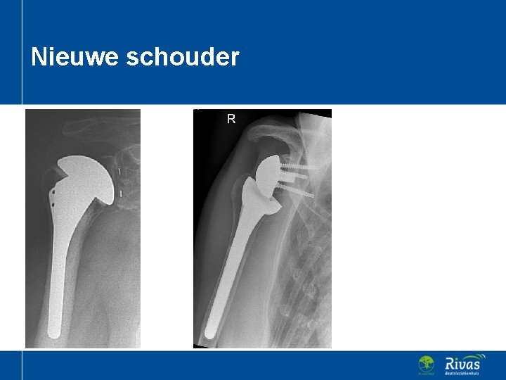 Nieuwe schouder 