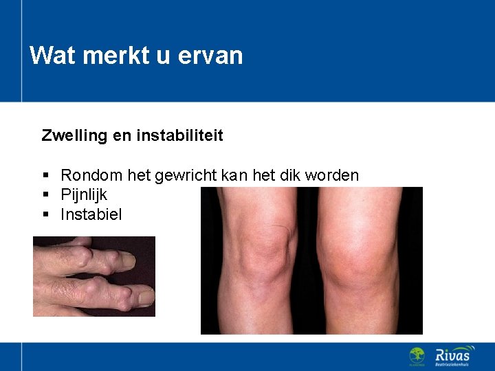 Wat merkt u ervan Zwelling en instabiliteit § Rondom het gewricht kan het dik