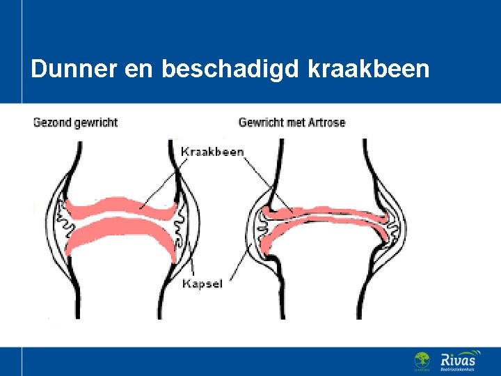 Dunner en beschadigd kraakbeen 