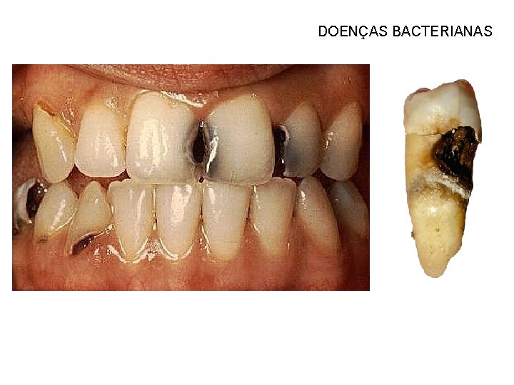 DOENÇAS BACTERIANAS 