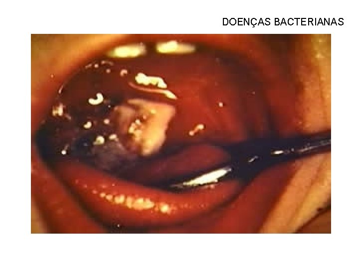 DOENÇAS BACTERIANAS 