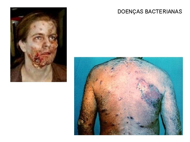 DOENÇAS BACTERIANAS 