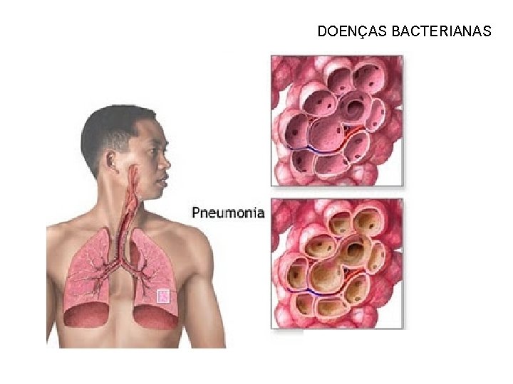 DOENÇAS BACTERIANAS 