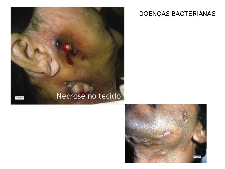 DOENÇAS BACTERIANAS Necrose no tecido 