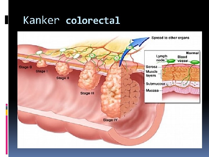 Kanker colorectal 