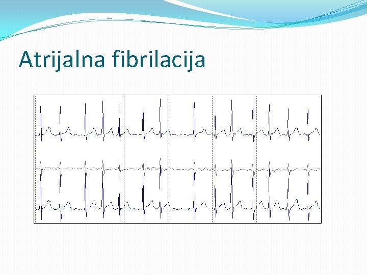 Atrijalna fibrilacija 