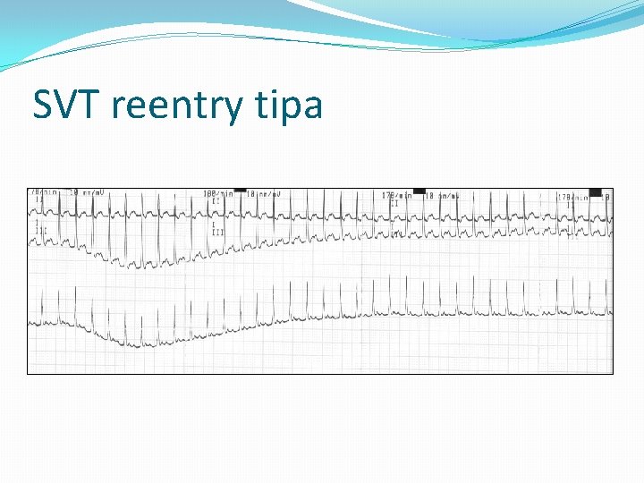 SVT reentry tipa 