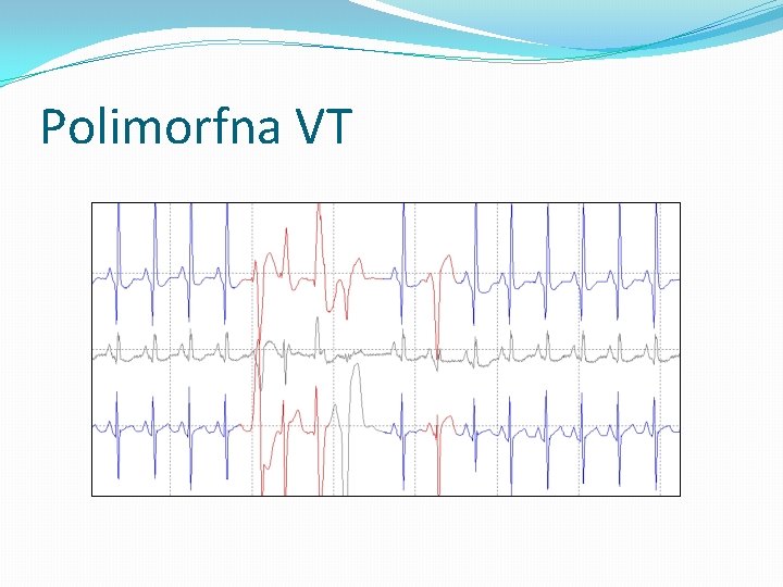 Polimorfna VT 