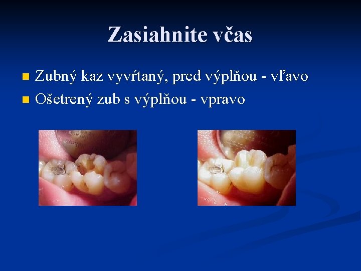 Zasiahnite včas Zubný kaz vyvŕtaný, pred výplňou - vľavo n Ošetrený zub s výplňou