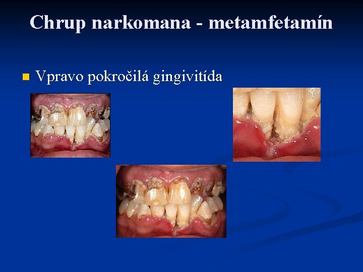 Chrup narkomana - metamfetamín n Vpravo pokročilá gingivitída 
