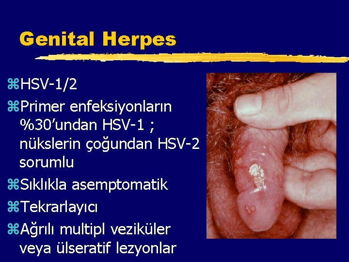 Genital Herpes z. HSV-1/2 z. Primer enfeksiyonların %30’undan HSV-1 ; nükslerin çoğundan HSV-2 sorumlu