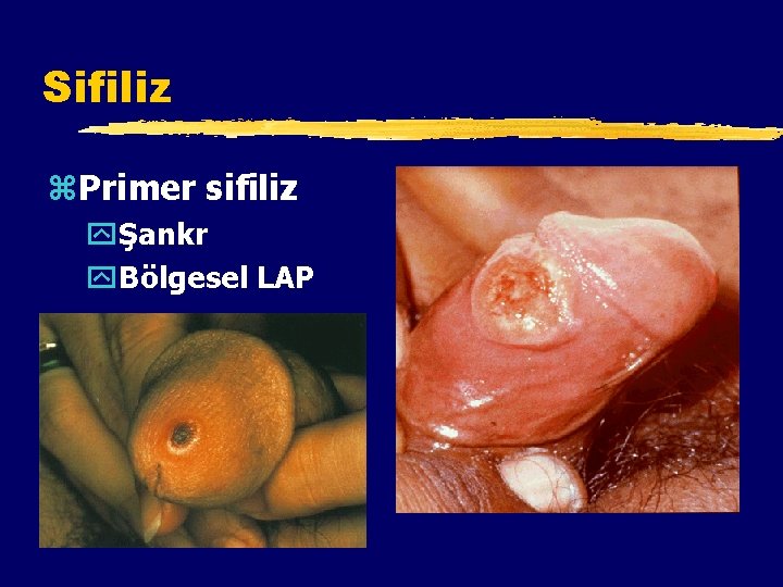 Sifiliz z. Primer sifiliz yŞankr y. Bölgesel LAP 