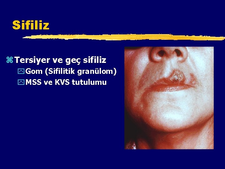 Sifiliz z Tersiyer ve geç sifiliz y. Gom (Sifilitik granülom) y. MSS ve KVS