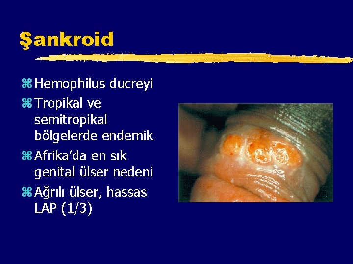 Şankroid z Hemophilus ducreyi z Tropikal ve semitropikal bölgelerde endemik z Afrika’da en sık