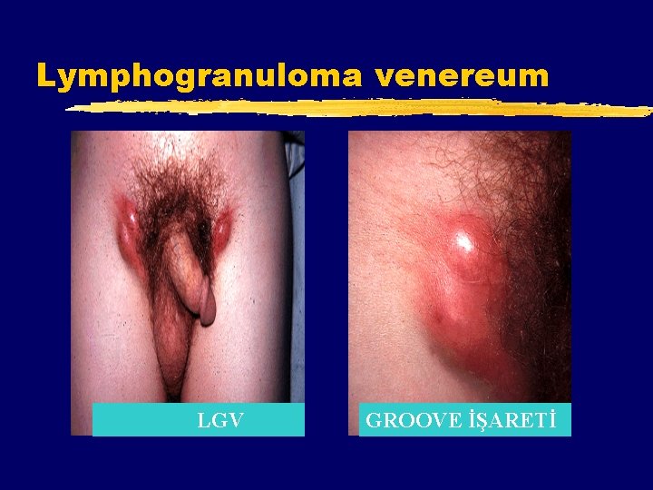 Lymphogranuloma venereum LGV GROOVE İŞARETİ 