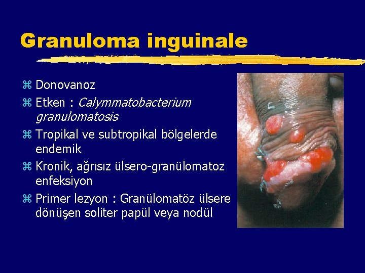 Granuloma inguinale z Donovanoz z Etken : Calymmatobacterium granulomatosis z Tropikal ve subtropikal bölgelerde