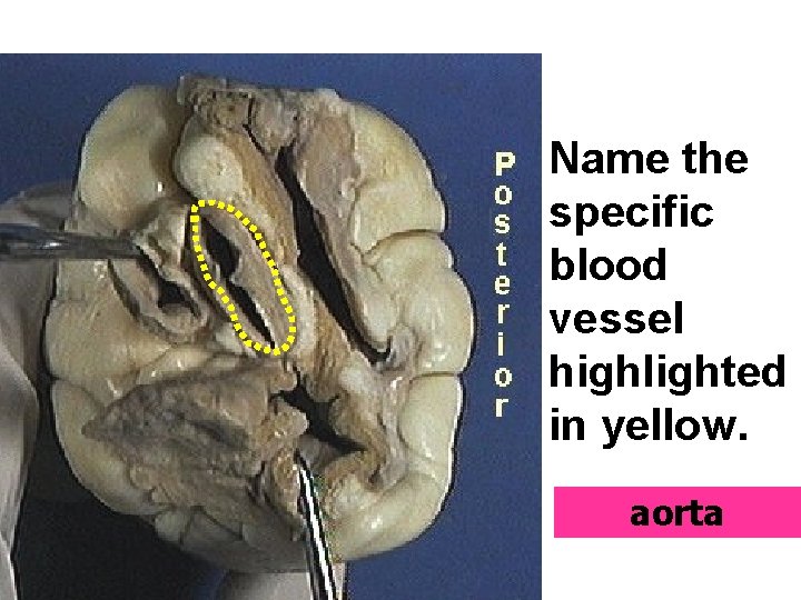 Name the specific blood vessel highlighted in yellow. aorta 