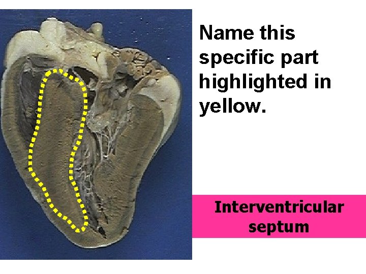 Name this specific part highlighted in yellow. Interventricular septum 