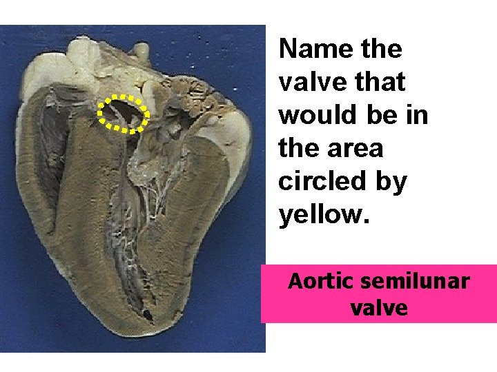 Name the valve that would be in the area circled by yellow. Aortic semilunar