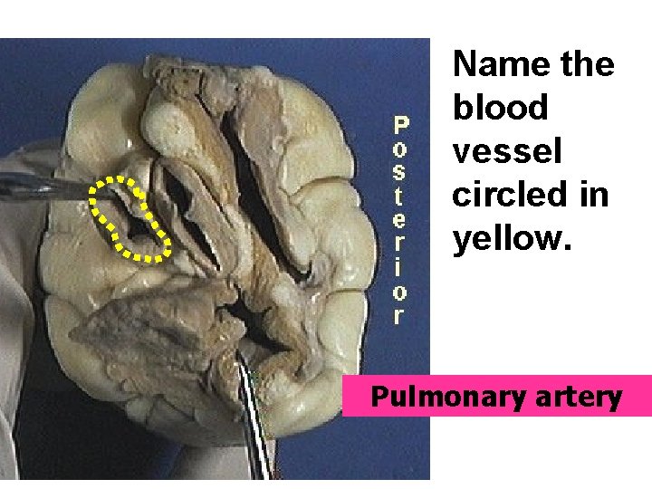Name the blood vessel circled in yellow. Pulmonary artery 