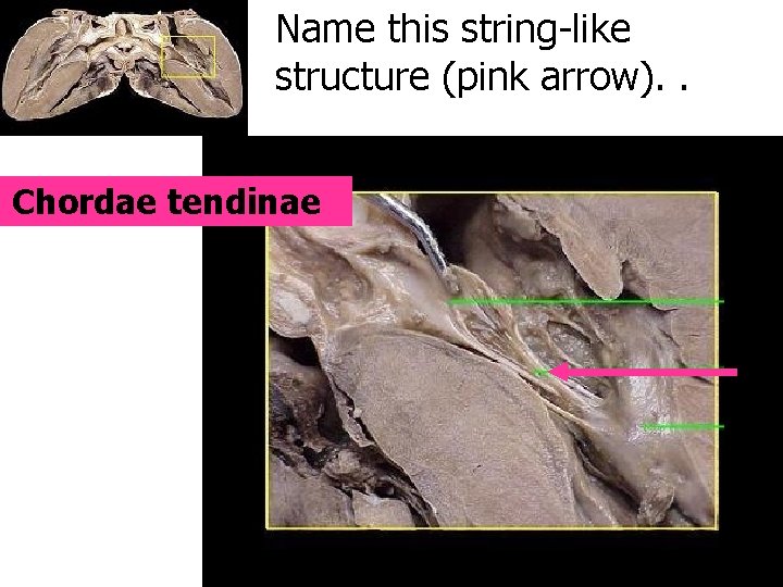 Name this string-like structure (pink arrow). . Chordae tendinae 