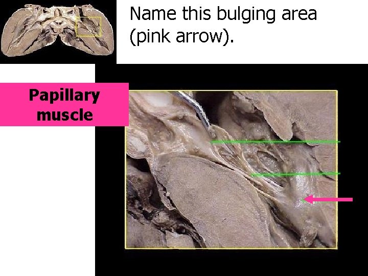 Name this bulging area (pink arrow). Papillary muscle 
