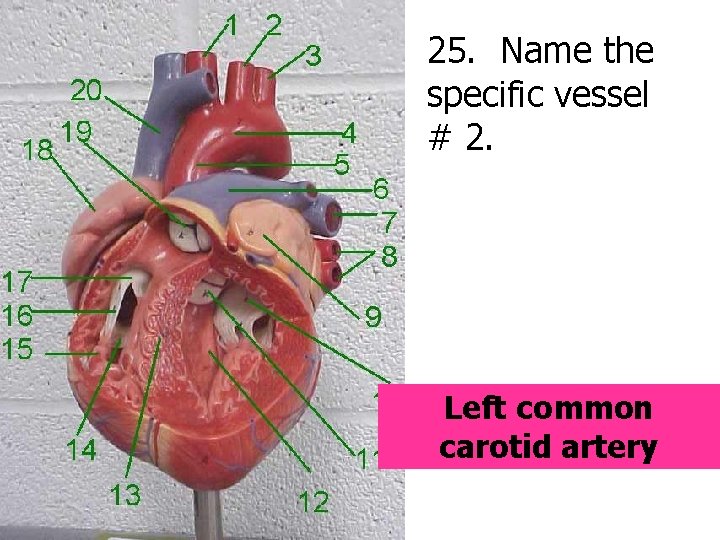 25. Name the specific vessel # 2. Left common carotid artery 